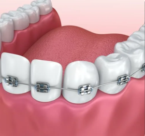 Traditional Braces in Sunset, FL | Braces in Miami, Florida